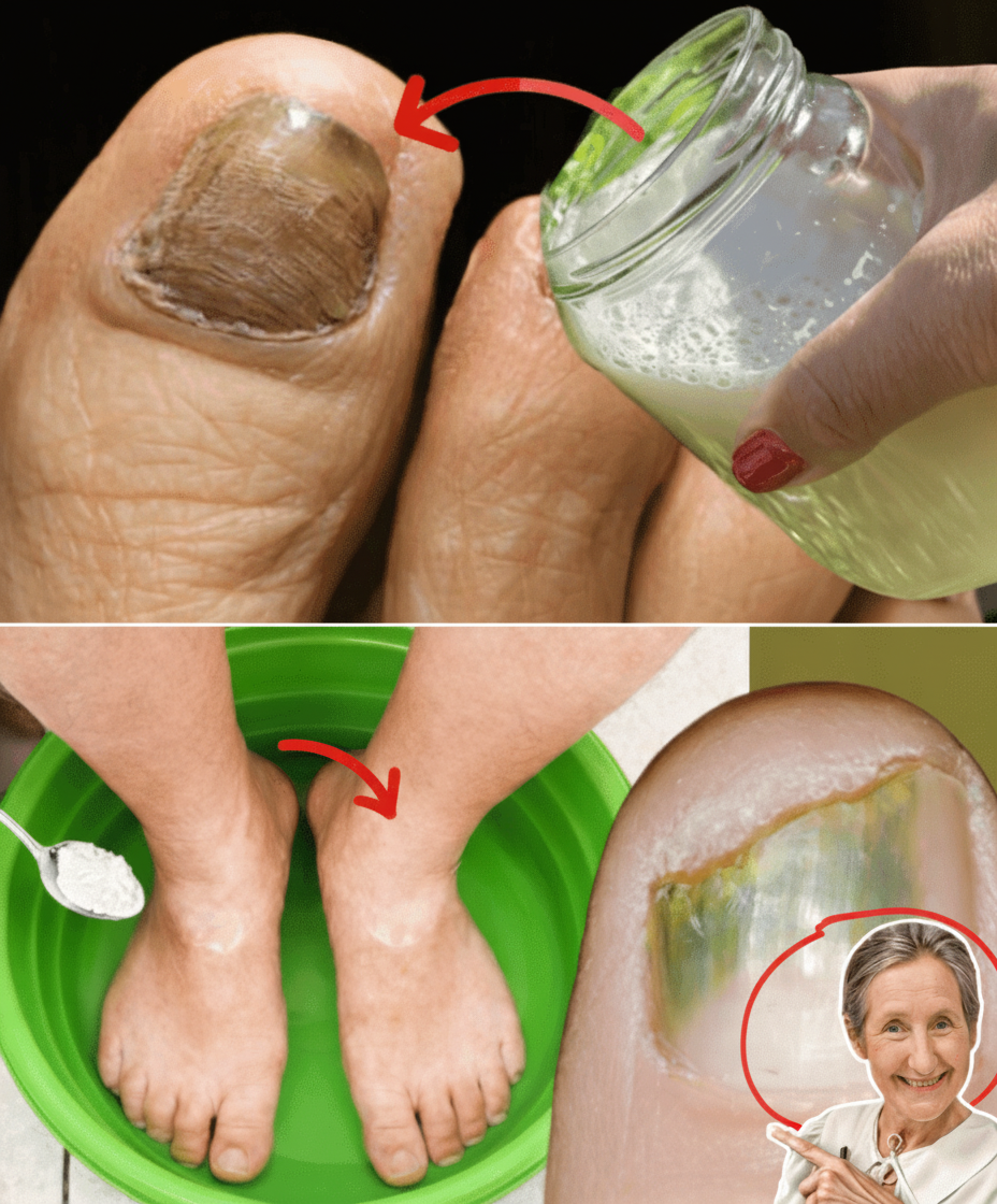 Effective Home Remedies for Nail Fungus: Natural Solutions for Healthy Nails